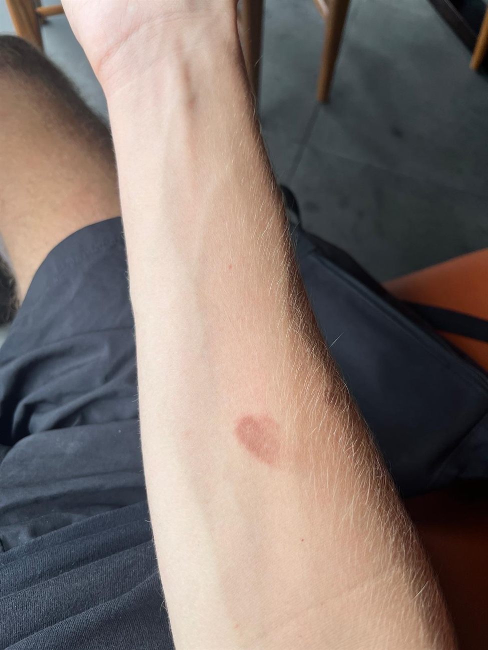 Dengue fever recovery phase